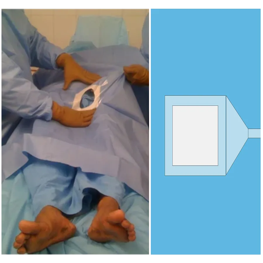 PCNL Drape
